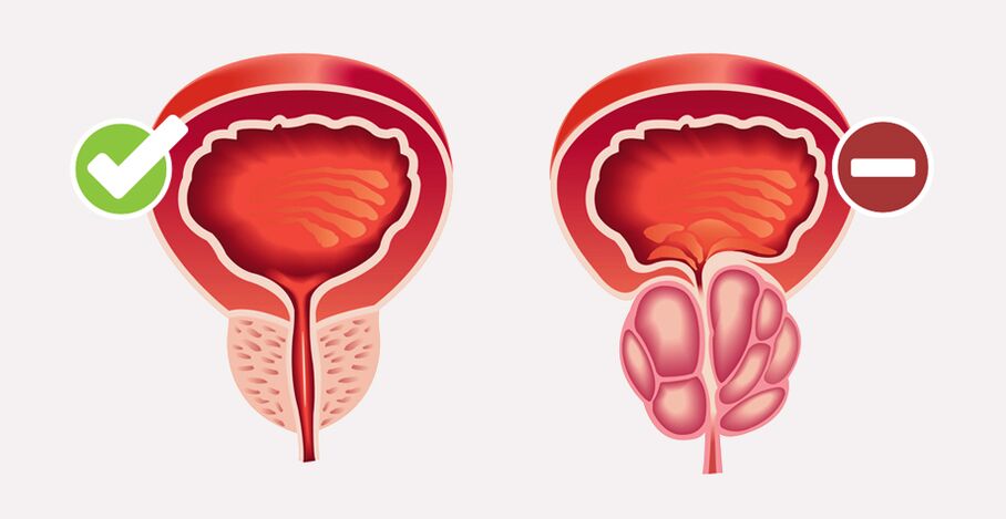 Prostamin Forte normaliza o tamanho e a função da próstata