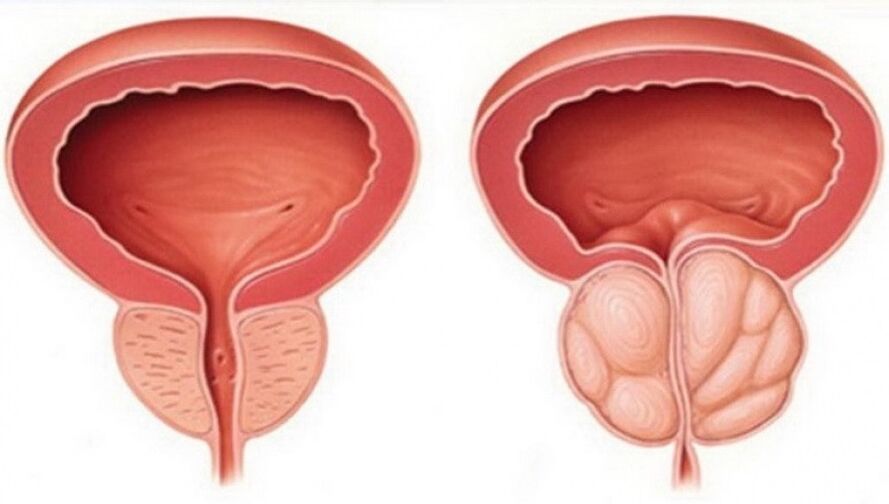 próstata saudável e inflamada com prostatite