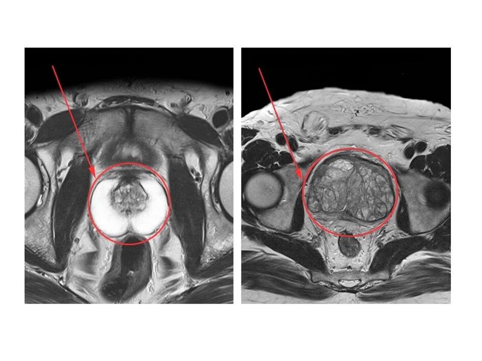 Comparação de uma próstata saudável (esquerda) e inflamada (direita) em imagens de ressonância magnética